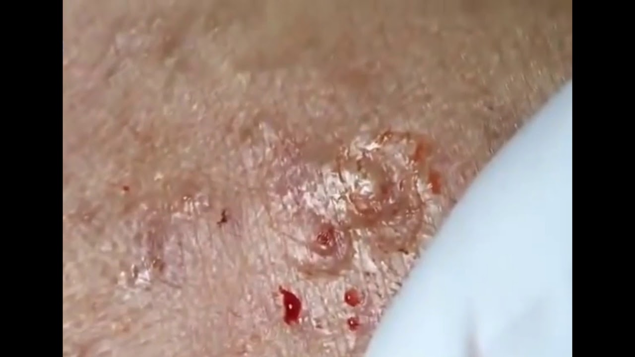 Remove Big Back Blackheads Part#31 - YouTube