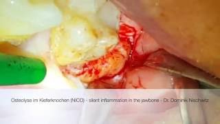 NICO Cavitation - neuralgia inducing cavitational osteonecrosis - Dr. Dominik Nischwitz