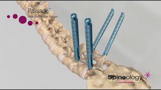 Spineology: Palisade Pedicular Fixation System Animation
