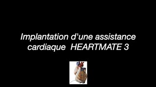 Implantation d'une assistance cardiaque - HeartMate 3™