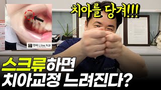 헉🤭 스크류하면 치아교정 느려진다...?