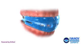 Orthodontic Braces Sports Mouthguard