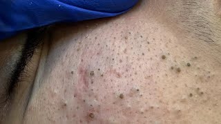 [ASMR] Facial Care Routine: Blackheads Removal & Deep Cleansing for Glowing Skin