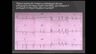 ეკგ. სამკონოვანი ბლოკადა / მეორე ხარისხის ატრიოვენტრიკულური ბლოკადა (მობიტცი 2 / მობიტცი II)