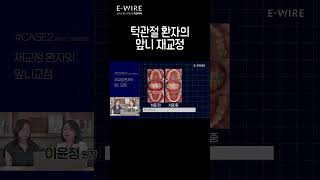 턱관절 환자의 앞니 재교정_talk