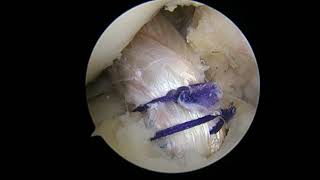 ACL Reconstruction All-Inside with Meniscus Repairผ่าตัดส่องกล้องเย็บซ่อมเอ็นไขว้หน้าและหมอนรองเข่า