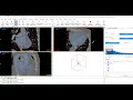 How to Semi-Automatically Segment Heart with CT Heart Tool