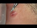 acne blackheads extraction with nasapham spa 24