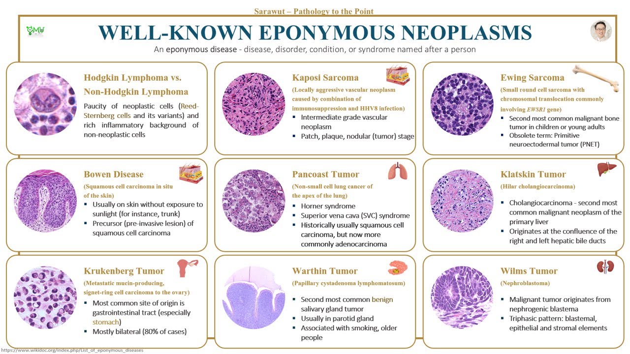 Patho Minutes Well Known Eponymous Neoplasms Youtube