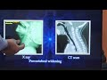 Acute Retropharyngeal Abscess / Tamil / Patient teaching programme