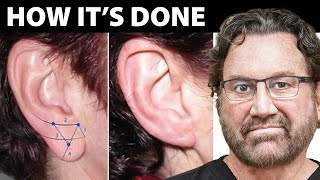 What technique is used for earlobe repair surgery? Plastic Surgeon Answers