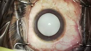 Hypermature cataract