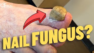 Cutting a Giant Thick Toenail (Satisfying Removal)