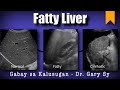 Fatty Liver - Dr. Gary Sy