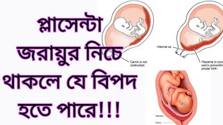 গর্ভফুল জরায়ু নিচে থাকলে করণীয়-pregnancy