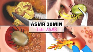 ASMR 30 Min Satisfying Collection Ear Cleaning: Earwax Removal, Ear Piercing, Sebum,...