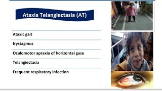 Ataxia Telangiectasia || Spot Diagnosis - 12 || Pediatrics