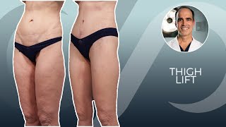 Before and After Thigh Lift Surgery with Dr. David Stoker