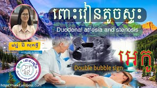 Duodenal atresia or Stenosis,ថោងឃឿន,គ្លីនិកថោងឃឿន,ជីសុគន្ធី,thorng,thorngkhoeurnclinic,chysokunththy