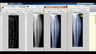 Bone Fracture Detection using Image Processing matlab Source code