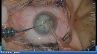 Intumescent white cataract,spiral rhexis