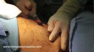 Fat Graft Harvest and Processing | Seattle Facial Fat Grafting