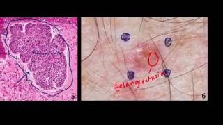 Introduction to NMSC Skin Cancer #2: Basal Cell Cancer (BCC) and Squamous Cell Cancer (SCC)