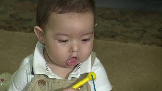 Complications caused by cleft palate; what doctors can do to correct it