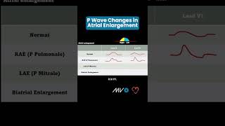 P Wave Changes in Atrial Enlargement