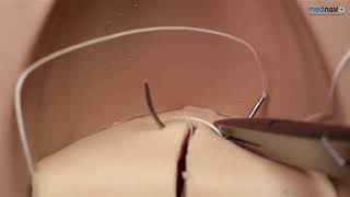 How to repair an episiotomy or 1st \u0026 2nd degree Perineal tear