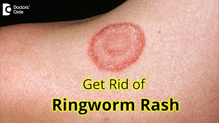 7 GREAT Tips for Prevention \u0026 Treatment of RINGWORM RASH- Dr. Amrita Hongal Gejje | Doctors' Circle