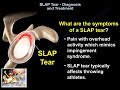 SLAP Tear Diagnosis & Treatment  - Everything You Need To Know - Dr. Nabil Ebraheim