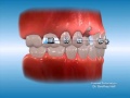 advanced orthodontics impaction