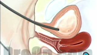 Cystoscopy Female Surgery, Patient Education