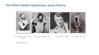 E04.1 Ehlers Danlos Syndromes and the Differential Diagnosis of Hypermobility