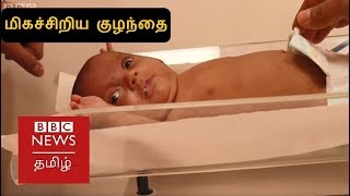 எடை 375 கிராம் - உள்ளங்கை அளவே பிறந்த குழந்தை