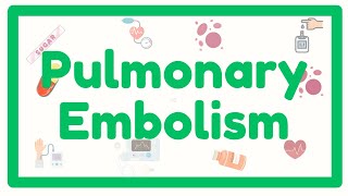 Why Pulmonary Embolism Is Life Threatening