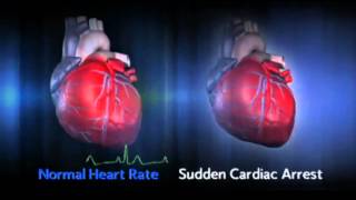 Sudden Cardiac Arrest (SCA)