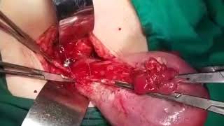 Hysterectomy on Gestational Trophoblastic Neoplasia