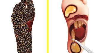 ASMR foot worms and ticks removal animation | ASMR maggots treatment animation feet