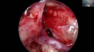 THE EANS WEBINAR: ENDOSCOPIC-ASSISTED MICROSURGICAL APPROACHES