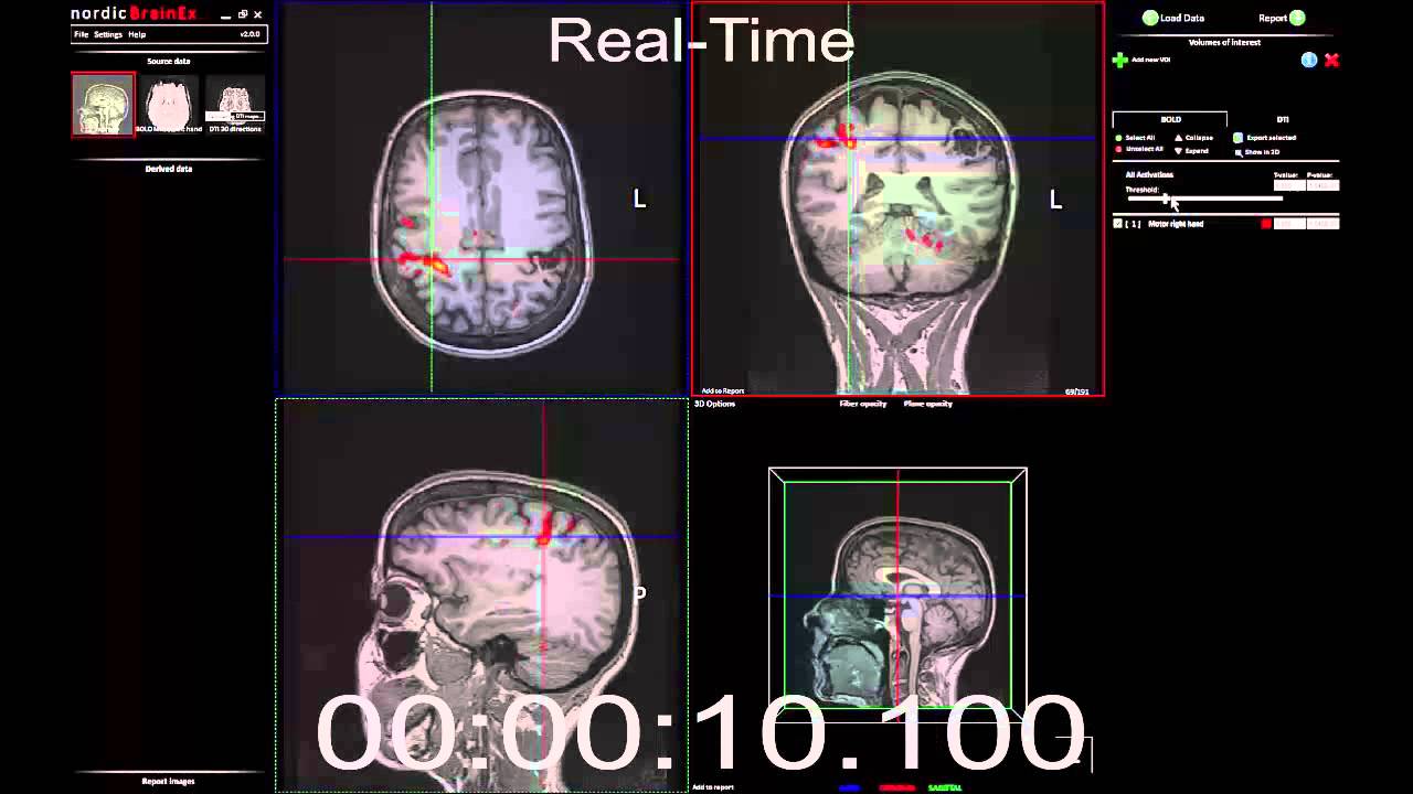 Fmri Analysis In 15 Seconds Youtube