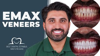 Full Set of Emax Veneers in Turkey