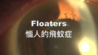 Floaters 飛蚊症