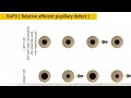 Relative afferent pupillary defect ( RAPD ) explained