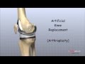 Artificial Knee Replacement