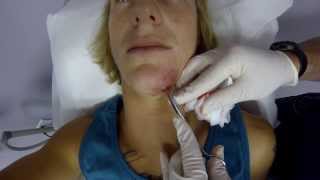 Lance and draining MRSA staph infection on face || VERY GRAPHIC 18+