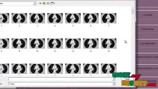 Final Year Projects | Early Detection and Prediction of Lung Cancer Survival
