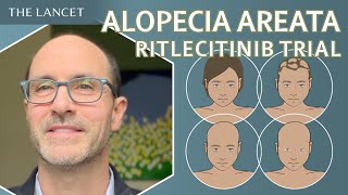Efficacy and safety of treating alopecia areata with ritlecitinib