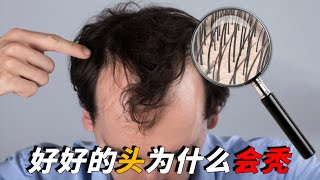 人為什麼會禿頭？把頭發放大1000倍告訴你，為什麼掉發的總是你